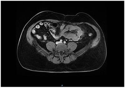 Primary Small Bowel Melanoma: A Case Report and Review of Literature
